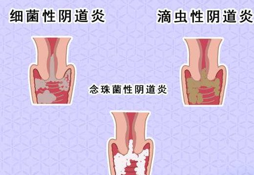 阴道分泌物香蕉国产精品剖析什么是细菌性阴道炎