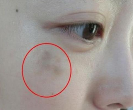 妇科阴道分泌物香蕉国产精品提醒女人妇科炎症在脸上的表现