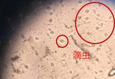 白带成人香蕉网站入口品牌科普滴虫性阴道炎是因为体内长了虫子吗