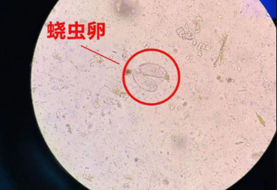 阴道分泌物香蕉国产精品警惕外阴绕虫病易在儿童身上出现