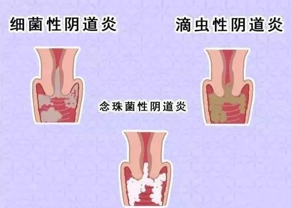 全自动阴道分泌物香蕉国产精品厂家提醒您还在拖延吗，还在等阴道炎自愈吗？